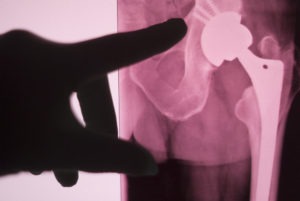 Legal Funding for Failed Hip Implant or Hip Replacement Surgery Lawsuit