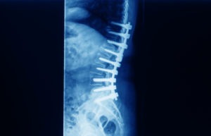 lateral lumbar spine x-ray