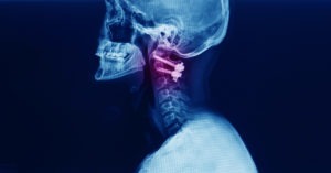lateral projection cervical spine x-ray showing neck fusion